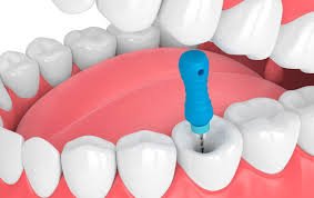 Single sitting Root Canal Treatment