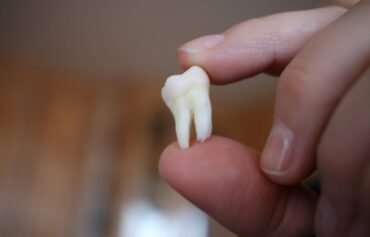 Wisdom tooth removal