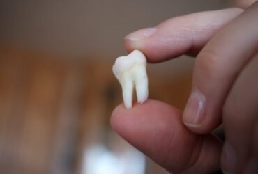 Wisdom tooth removal