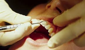 Tooth extractions