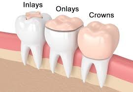 Inlay and onlays