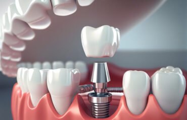 Dental Implants Treatment