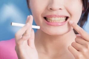 How to Remove Teeth Stains Caused by Smoking