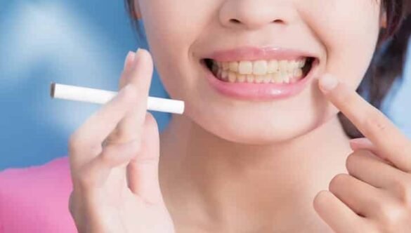 How to Remove Teeth Stains Caused by Smoking