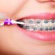 Caring for Your Teeth After Straightening Treatment