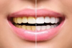 Yellow teeth solution: 5 Proven Teeth Whitening Techniques for Yellow Stained Teeth