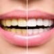 Yellow teeth solution: 5 Proven Teeth Whitening Techniques for Yellow Stained Teeth