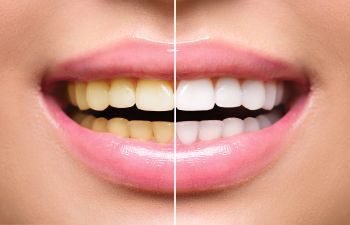 Yellow teeth solution: 5 Proven Teeth Whitening Techniques for Yellow Stained Teeth